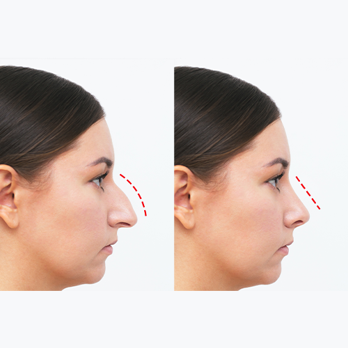 rhinoplasty - nose shape